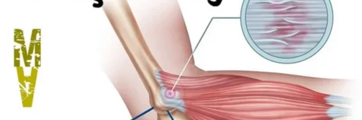 Tennis Dirsəyi Və Müalicəsi