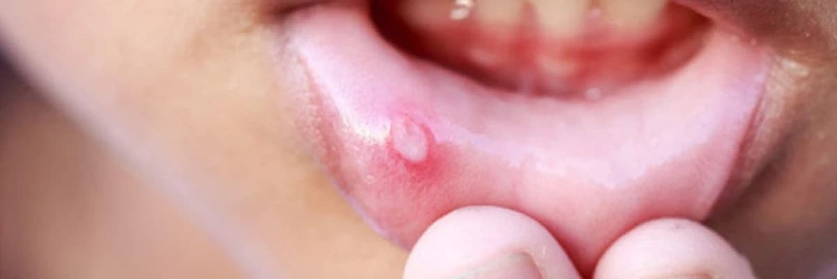 Pemfiqus və pemfiqoidlər