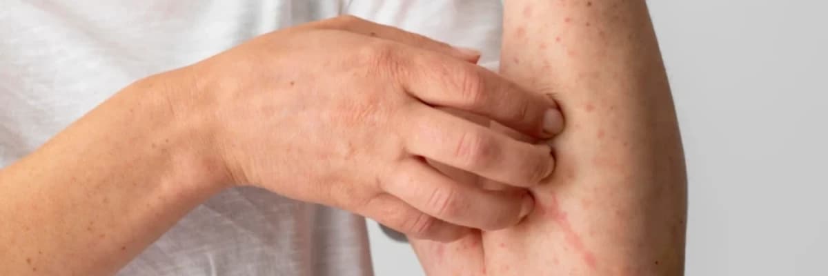 Atopik dermatit ( Ekzema )