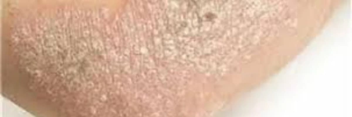 Sedef, liken və bənzər dermatit