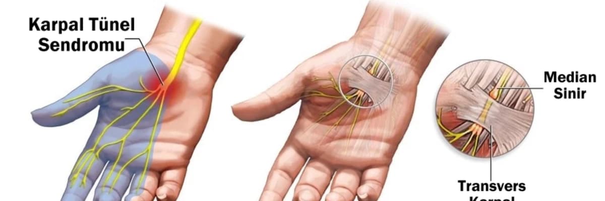 Karpal tunel sindromu nədir?