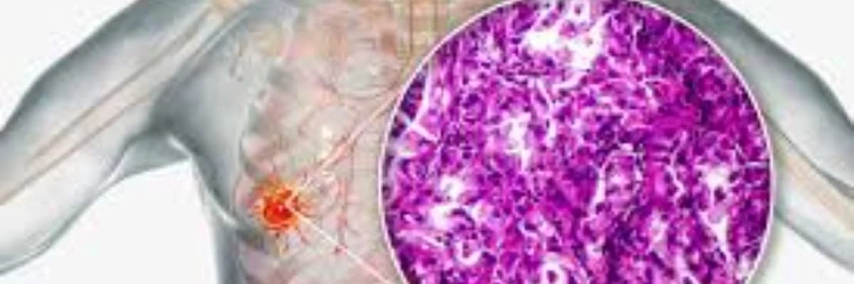 Ağciyər xərçəngi maye terapiyası nədir?