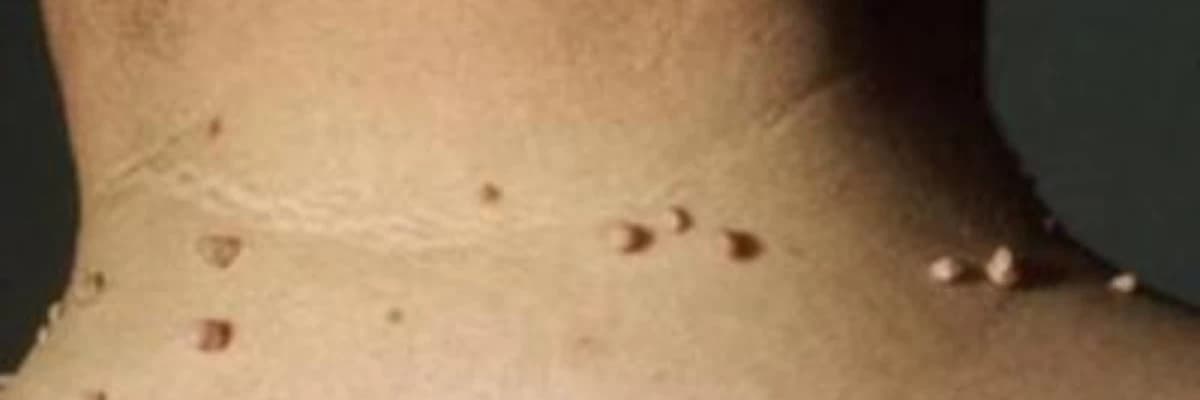 Ət xalları və papillomalar