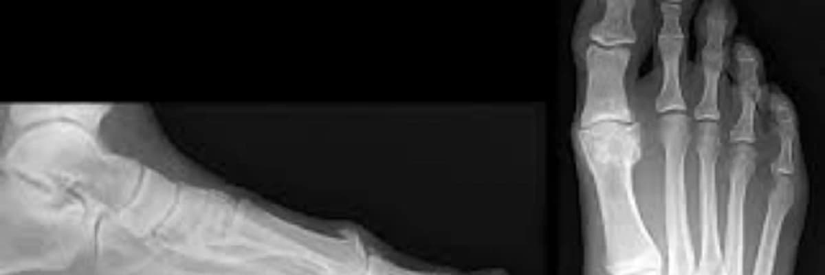 Hallux rigidus xəstəliyi