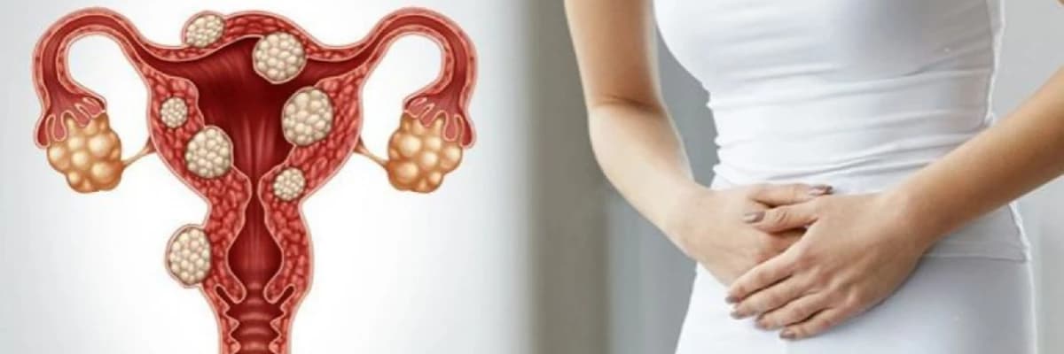 Uşaqlıq miomaları