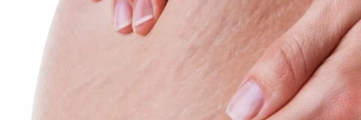 Dəridəki çatlaqlar - Hamiləlikdə çatlar