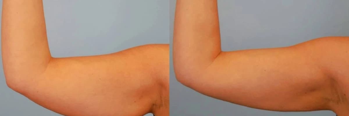 Qol Gərmə (Braxioplastika): Möhkəm və Estetik Qolların Açarı