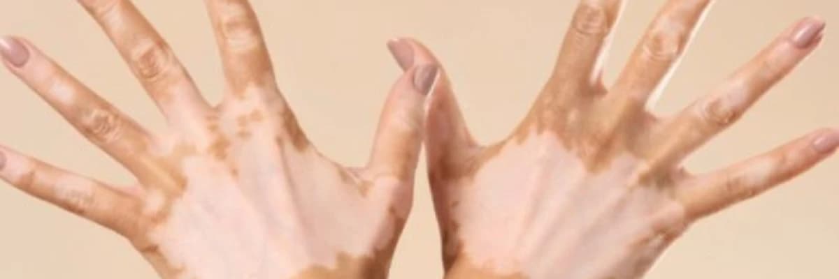 Dırnaq xəstəlikləri