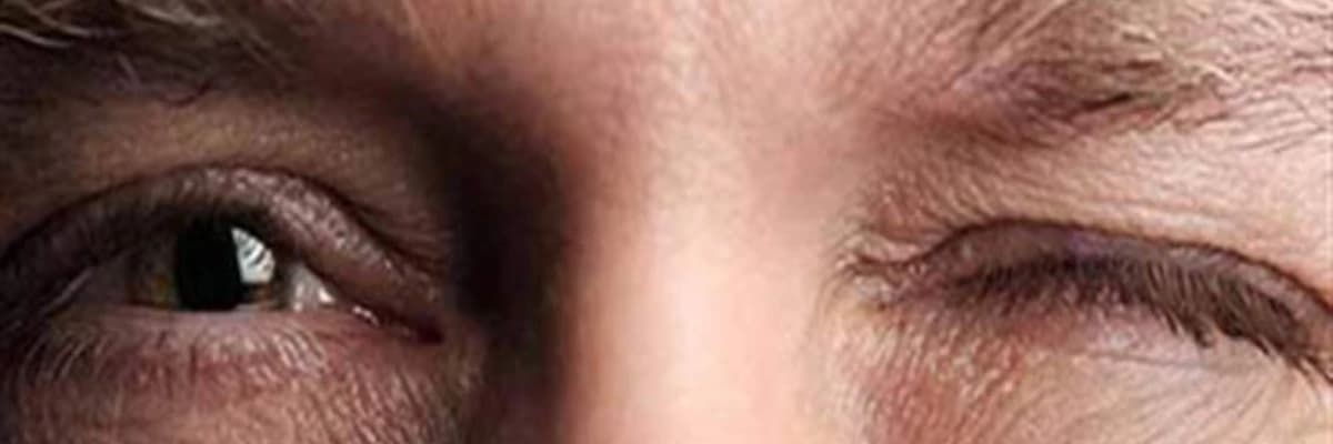 Göz qapaqlarının sallanması və göz qapaqlarının şişməsi