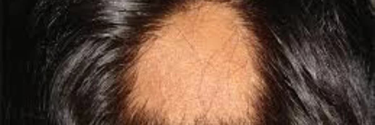 Saç Tökülməsi və Alopeçiya: Səbəbləri, Növləri və Müalicə Yolları