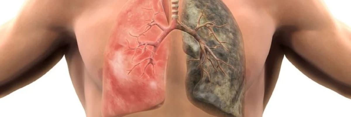 Ağciyər xərçəngi