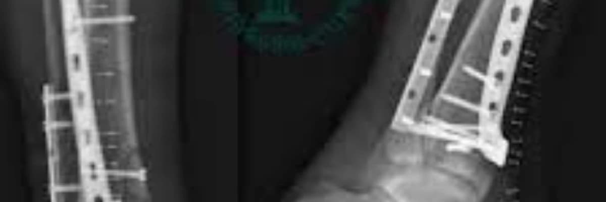 Osteosintezın bütün növləri