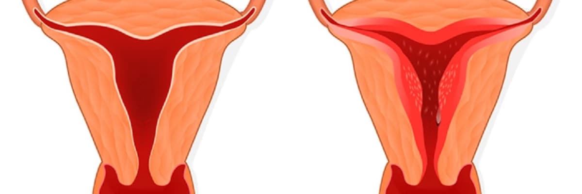Endometriumun aspirasiya ilə biopsiyası