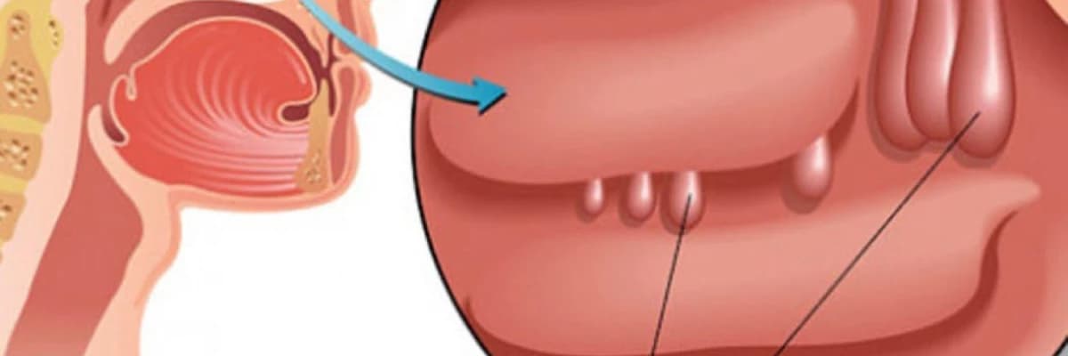 Burun Polipləri nədir?