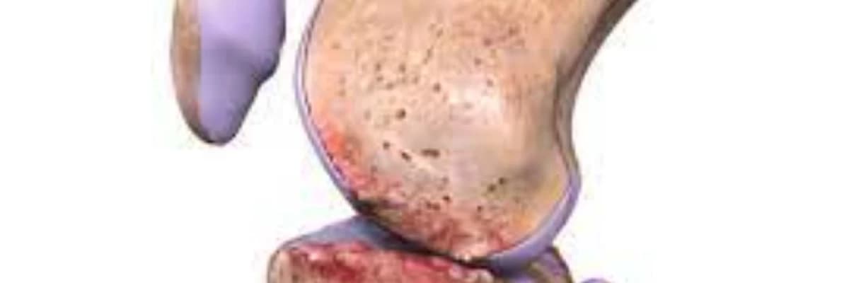 Osteoartrit