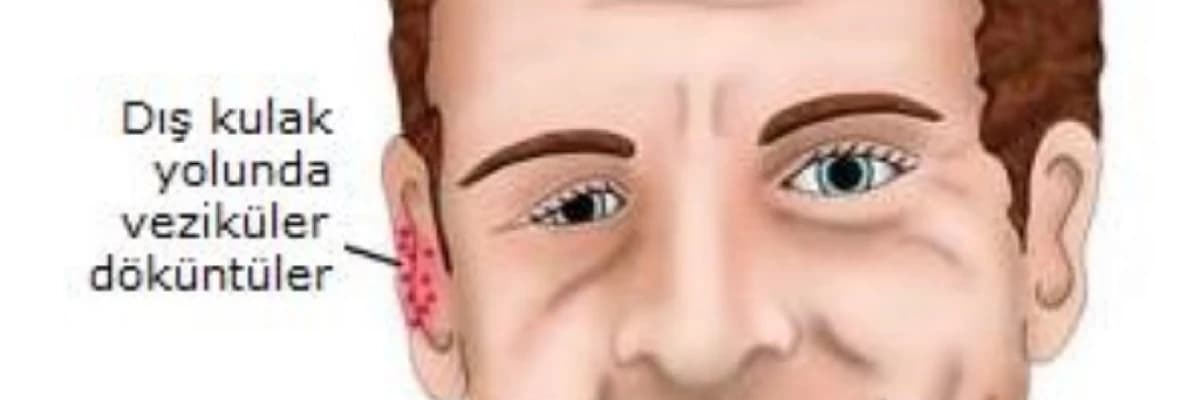 Ramsay Hunt Sindromu nədir? Simptomlar və Müalicə