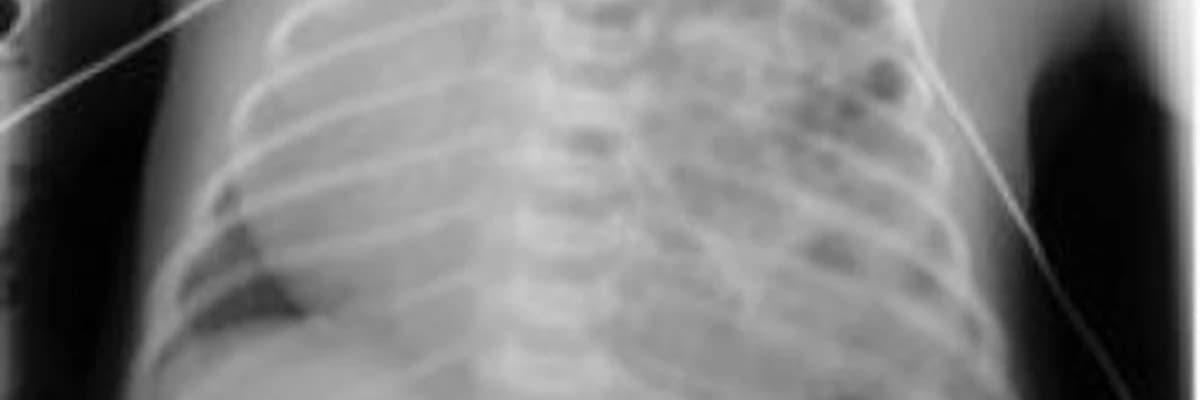 Uşaqlarda diafraqma yırtığı. Diafraqma qrijası.