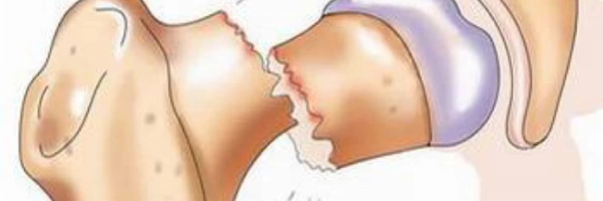 Sümük Sınıqları: Diaqnoz, Müalicə və Sağalma Prosesi