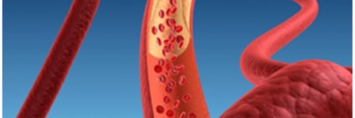 Hiperxolesterolemiya