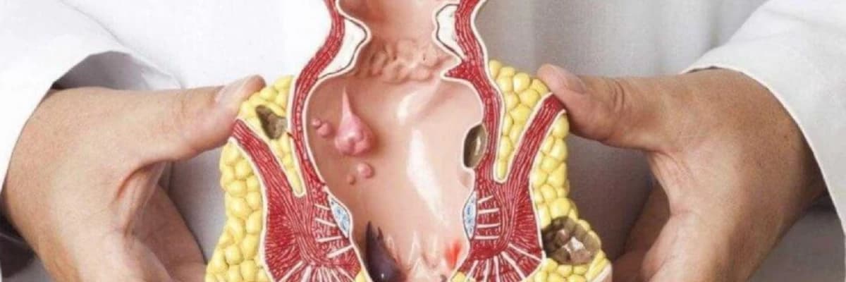 Babasil (xroniki və kəskinləşməsi)