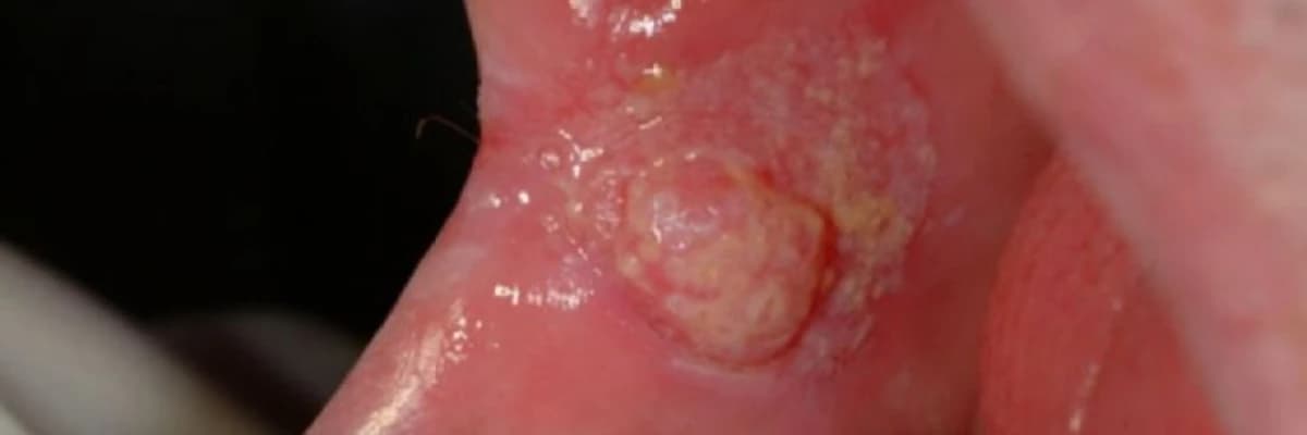 Ağız və mukoza xəstəlikləri