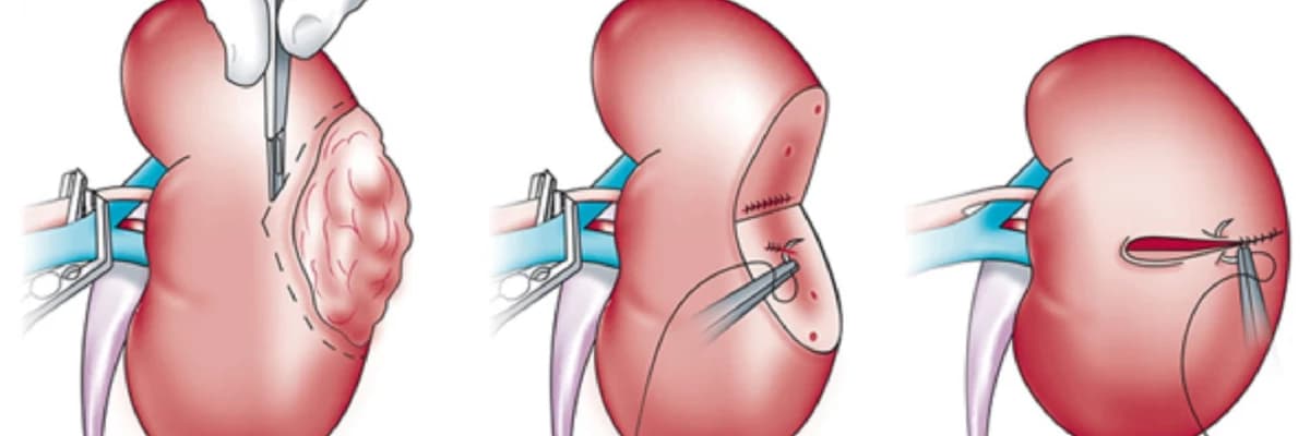 BÖYRƏK XƏRÇƏNGİ