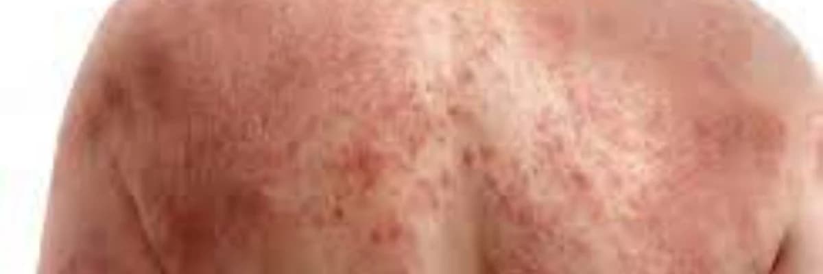 Dərinin allergik xəstəlikləri