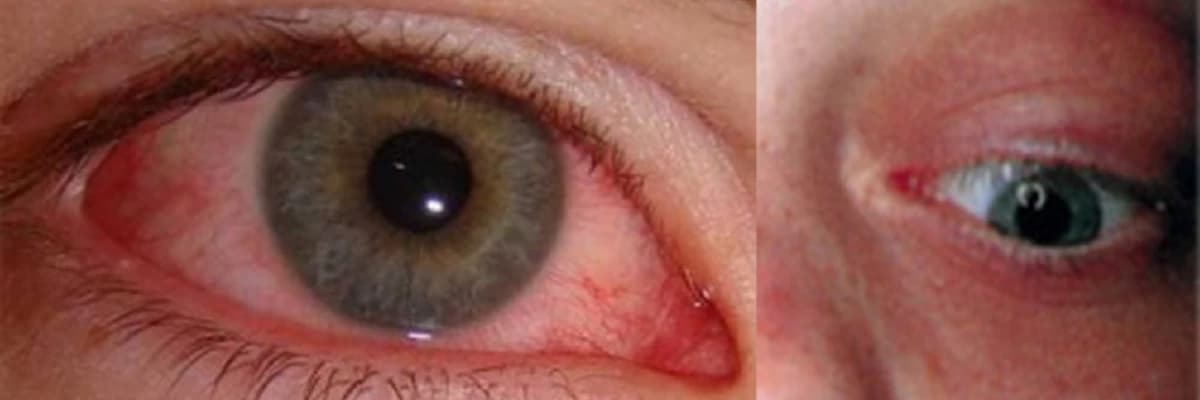 Gözün infeksiyon xəstəliklərinin müalicəsi