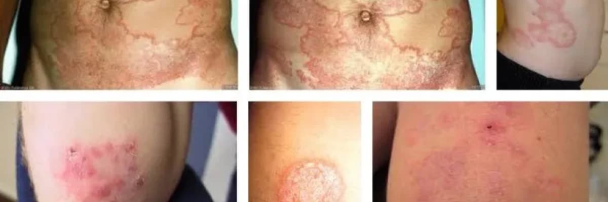 Tinea Corporis (Bədən nahiyyəsinin göbələyi)