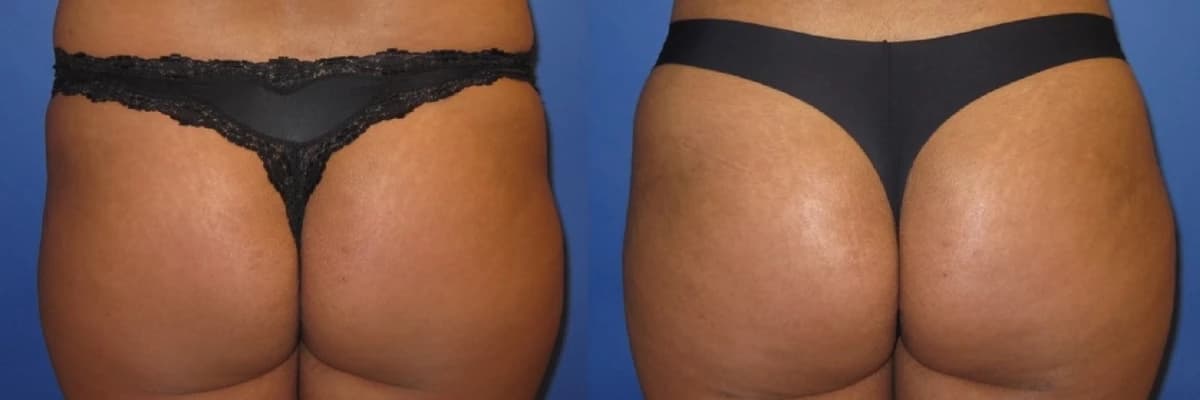 Popoplastika (Piylə) Cərrahisi: Estetik və İncə Xüsusiyyətlər