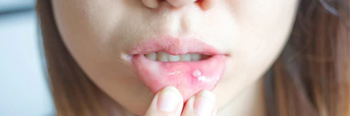 Dodaq, dil və ağız boşluğu xəstəlikləri (xərçəng yaraları, herpes və ağızdakı digər xəstəliklər)