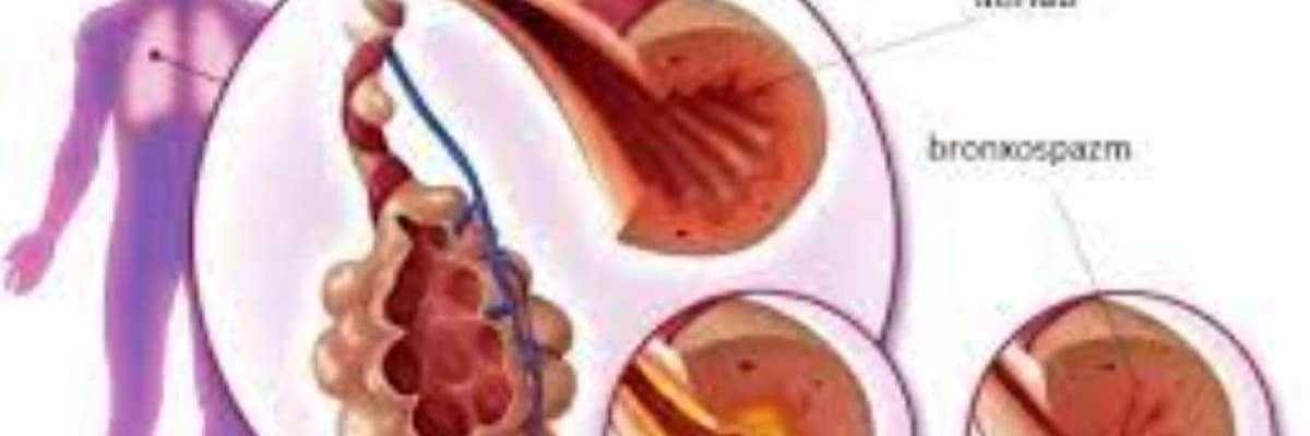 Bronxial astma