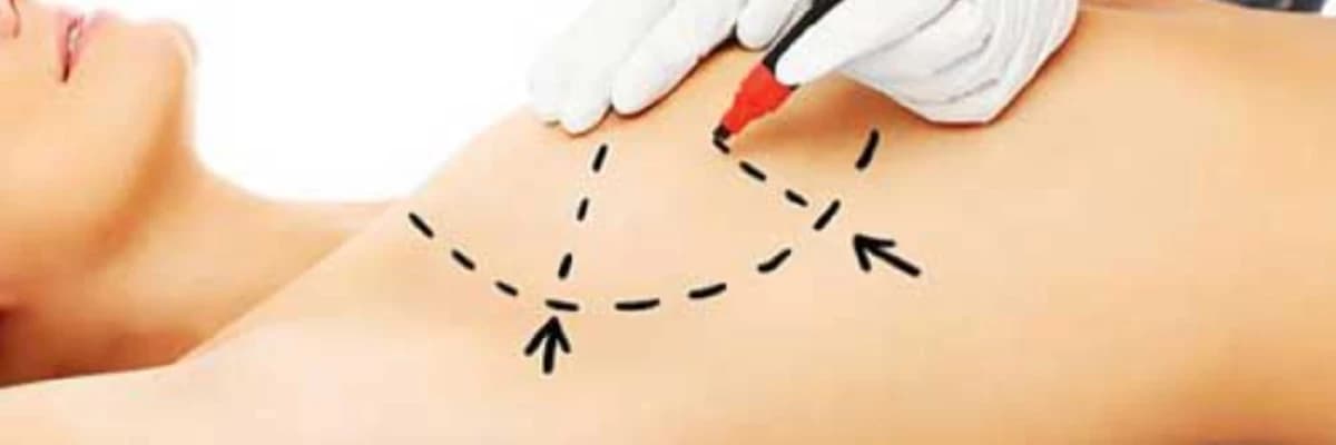 Döş Estetikası: Mammoplasti