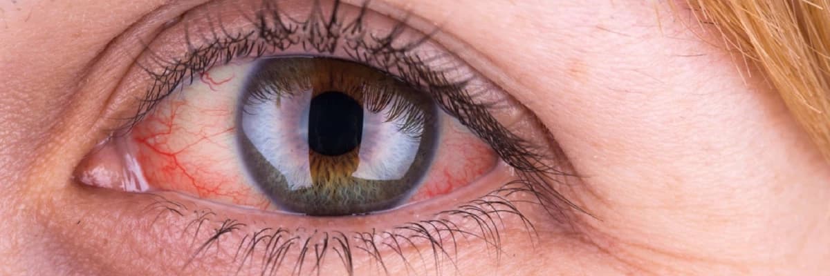 Göz ətrafındakı dəri və gözlərin qızarması