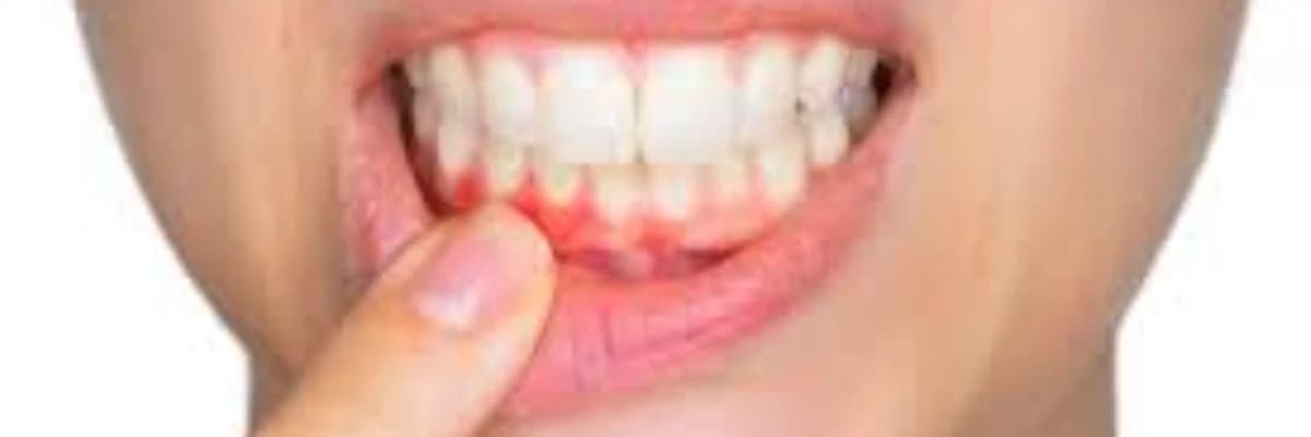 Diş əti xəstəlikləri və müalicəsi