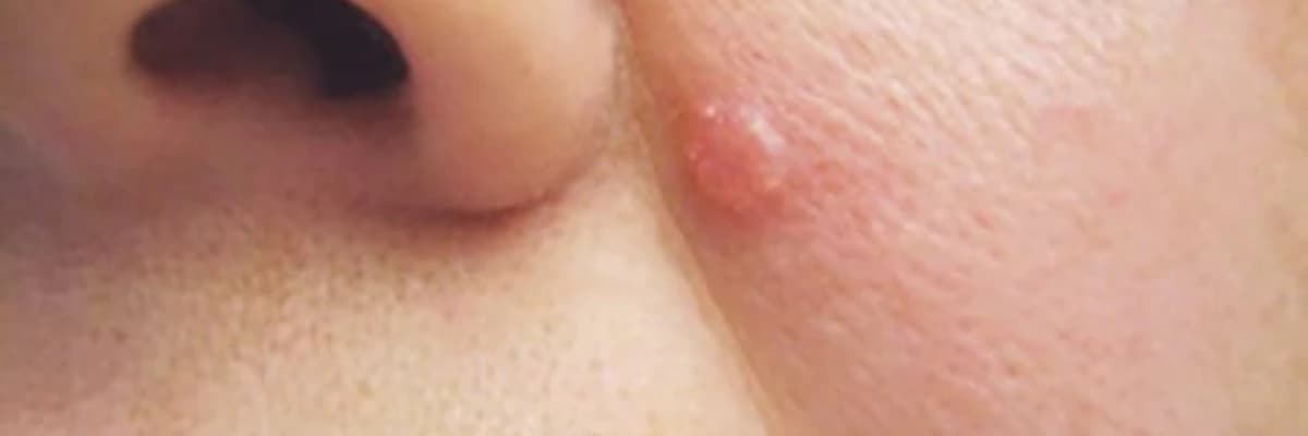 Bazal Hüceyrəli Karsinoma