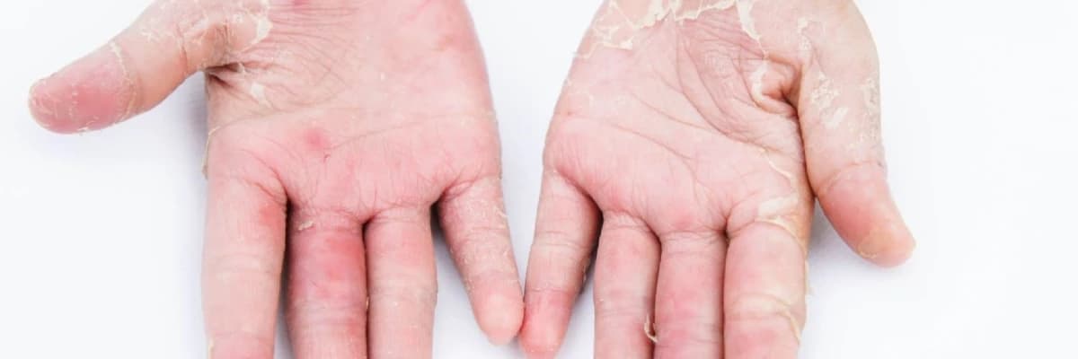 Kontakt Dermatit: Dəriyə Təmasın Nəticələri