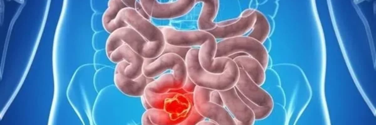 Nazik bağırsaq xərçəngi