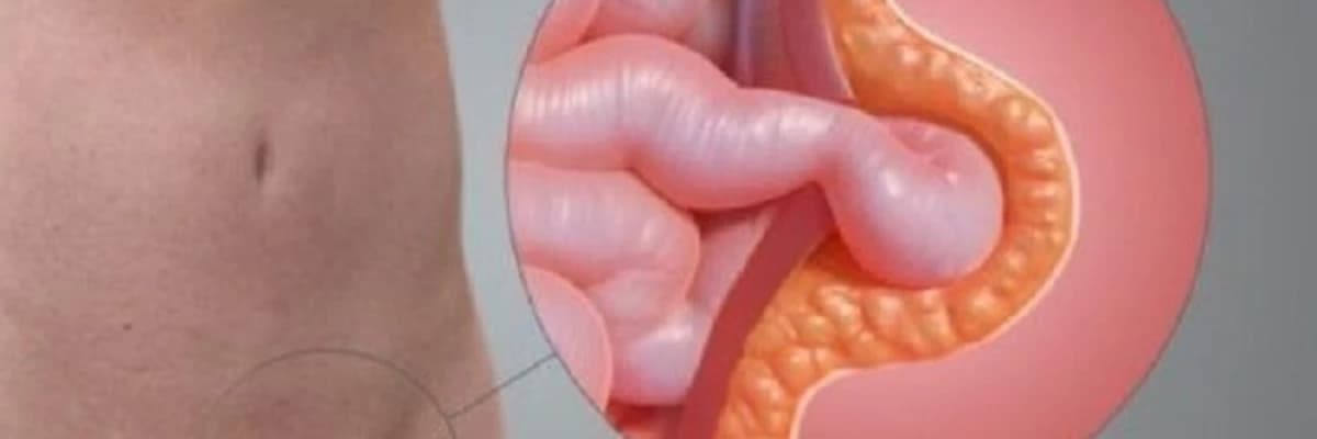 Uşaqlarda qasıq yırtığının diaqnozu və cərrahi müalicəsi