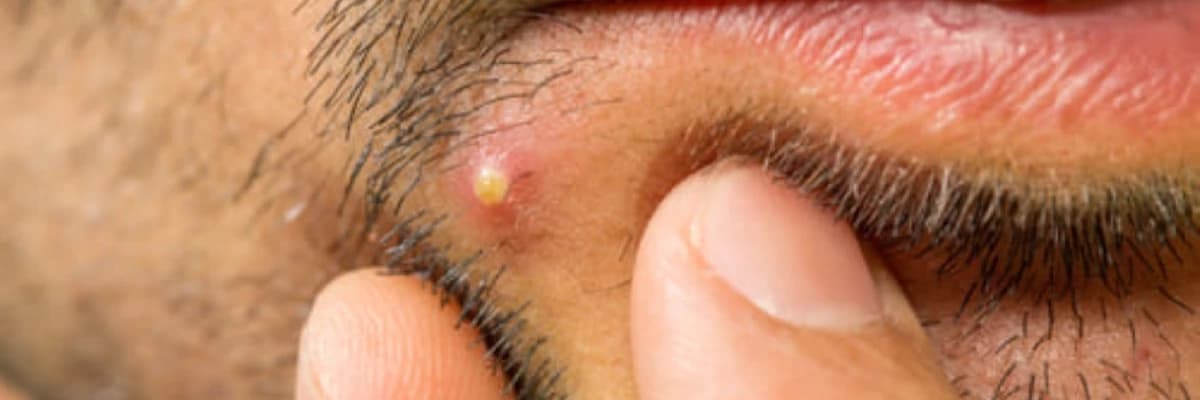 Furunkul: Dərin Doku İltihabını Anlamaq