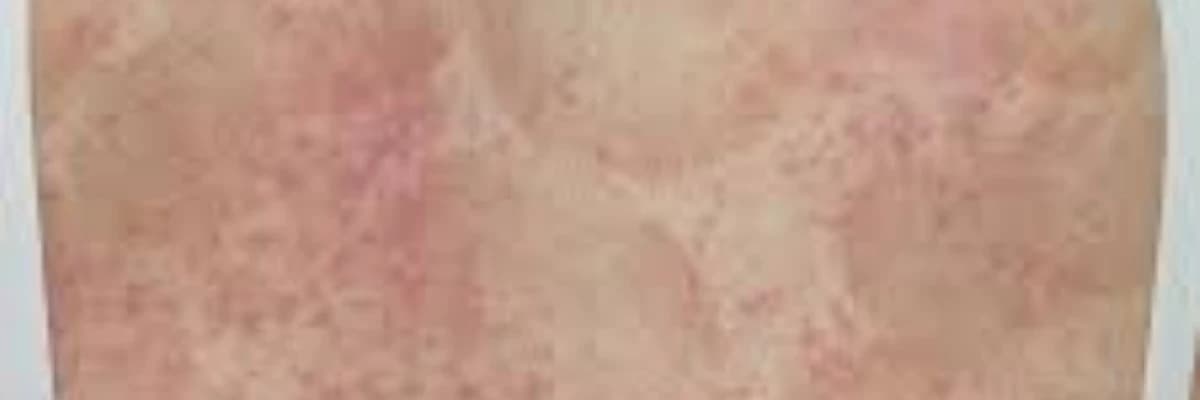 Dərman allergiyası