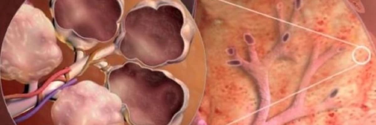 Ağciyərin anadangəlmə xəstəlikləri (sekvestrlər, bronxogen kistlər və s.)