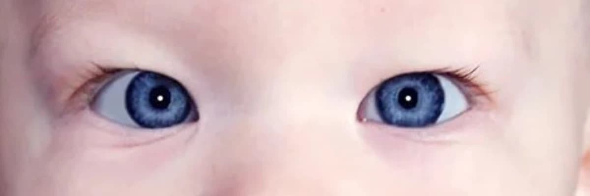 Çəpgözlük (Strabismus) müalicəsi