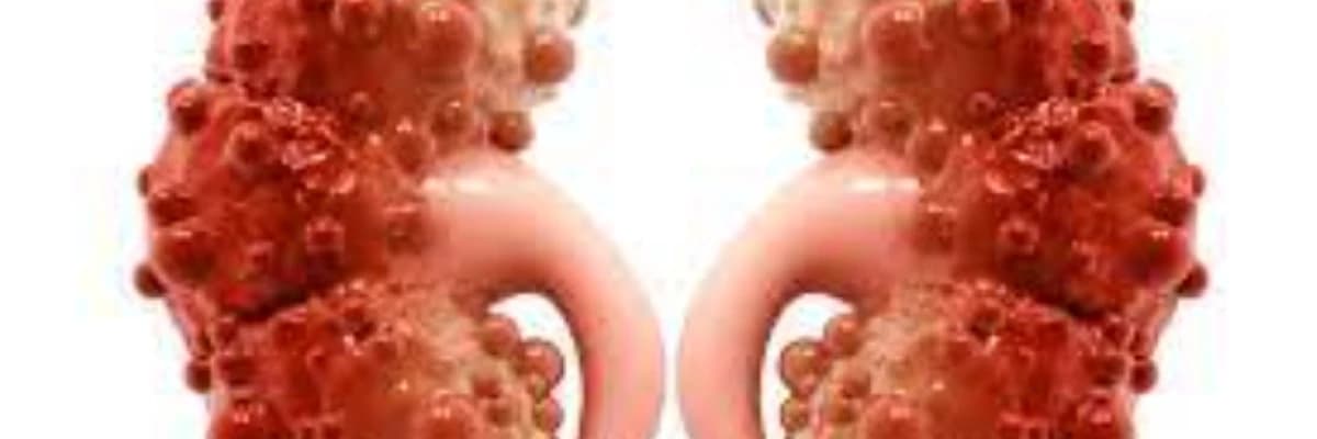 Böyrək kisti nədir? Müalicə edilməlidir?