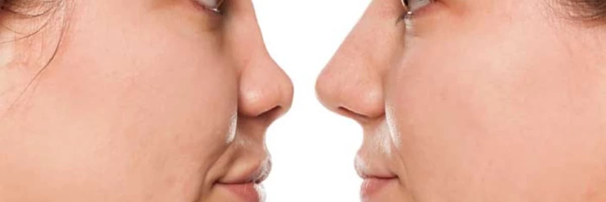 Revizyon Rinoplastika