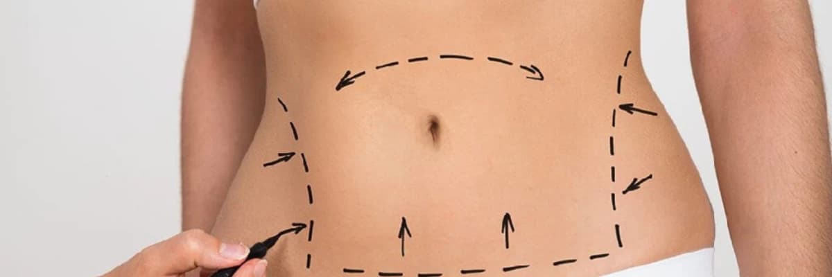 Lipoabdominoplastika