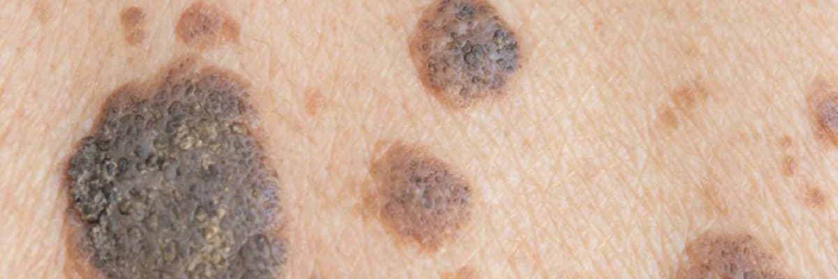 Keratoz: Dərinin Qalınlaşması və Nəzərə Alınması