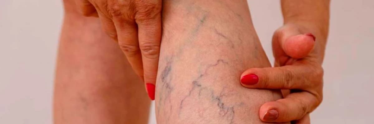 Varikoz (venoz çatışmazlıq)