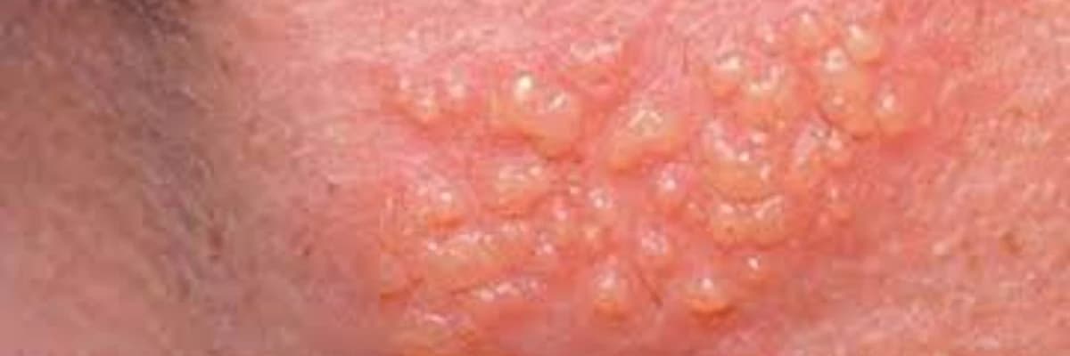 Genital herpes