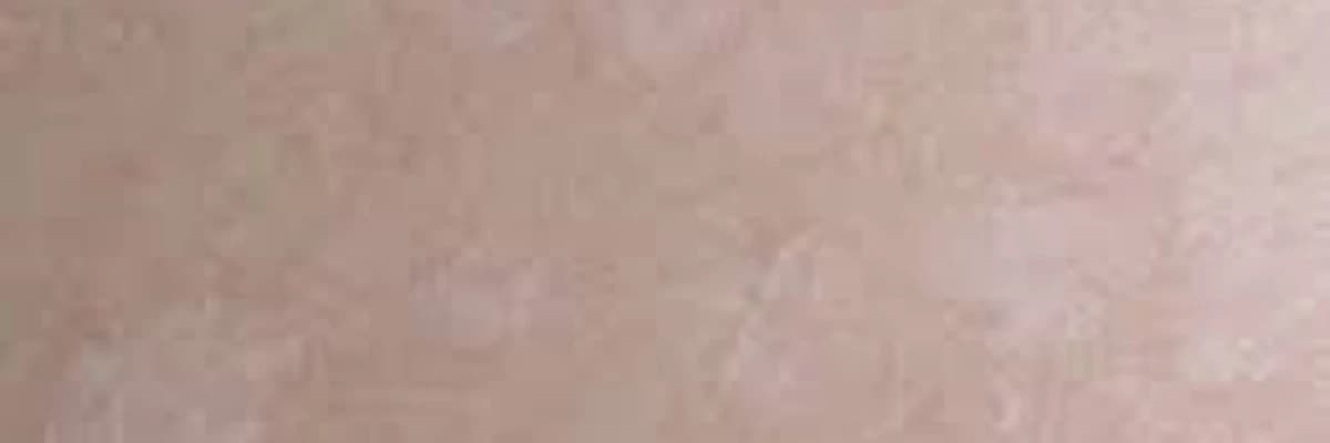 Dəmrovabənzər pitiriaz